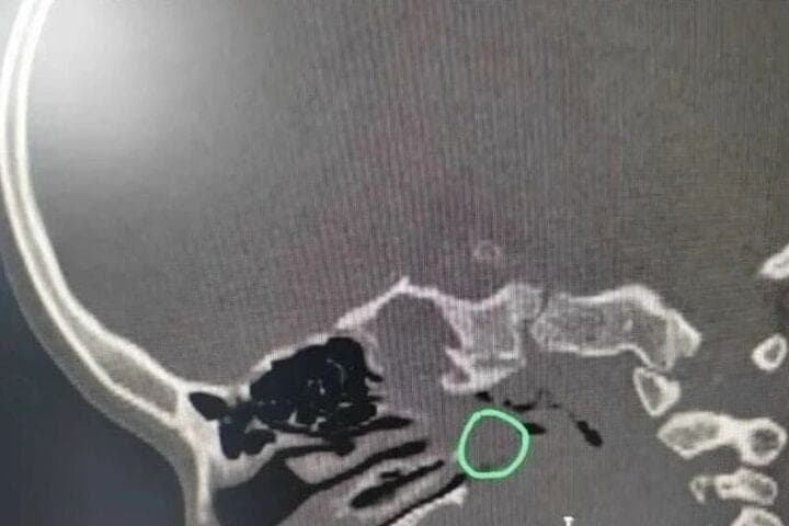 Воронежские ЛОР-врачи прооперировали пятилетнюю девочку с воспалением клиновидной пазухи