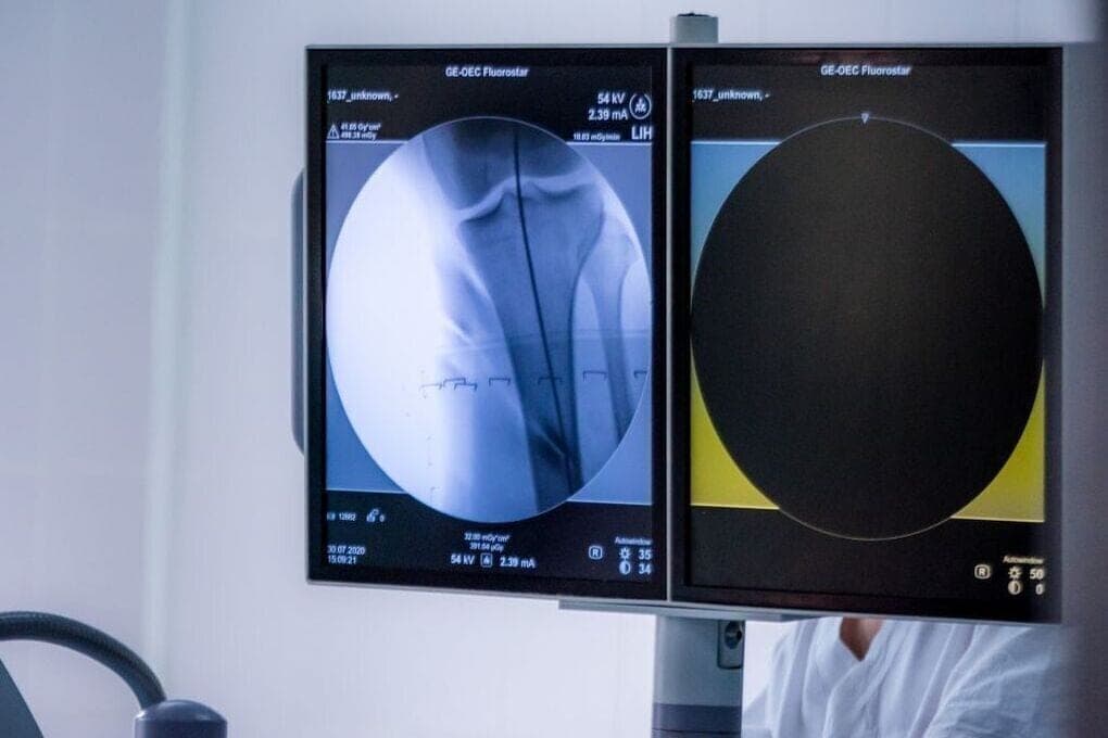 Chelyabinsk explained why bones become fragile and how to reduce the risk of fractures