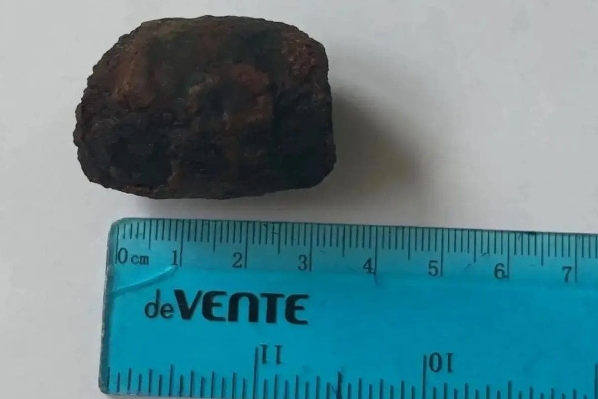 في منطقة (ليبتسك)، أزال الجراحون حجراً ضخماً حجب الأمعاء