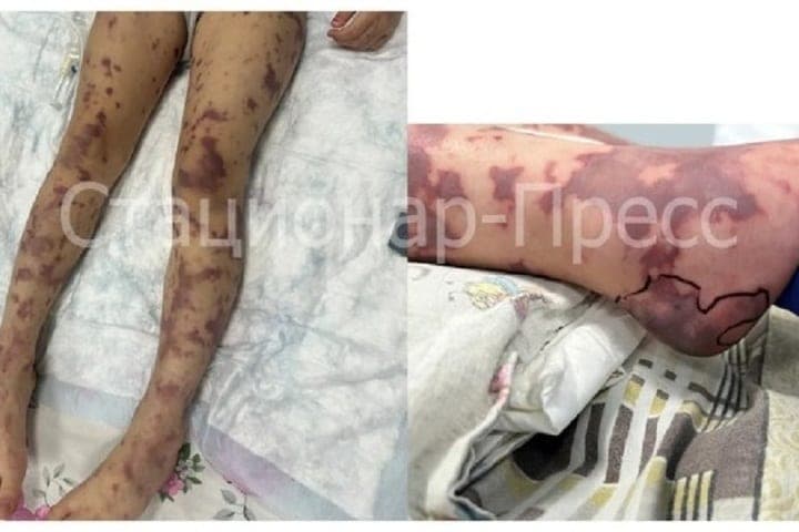 Nizhny Novgorod doctors saved the child with " unsavable variant" disease