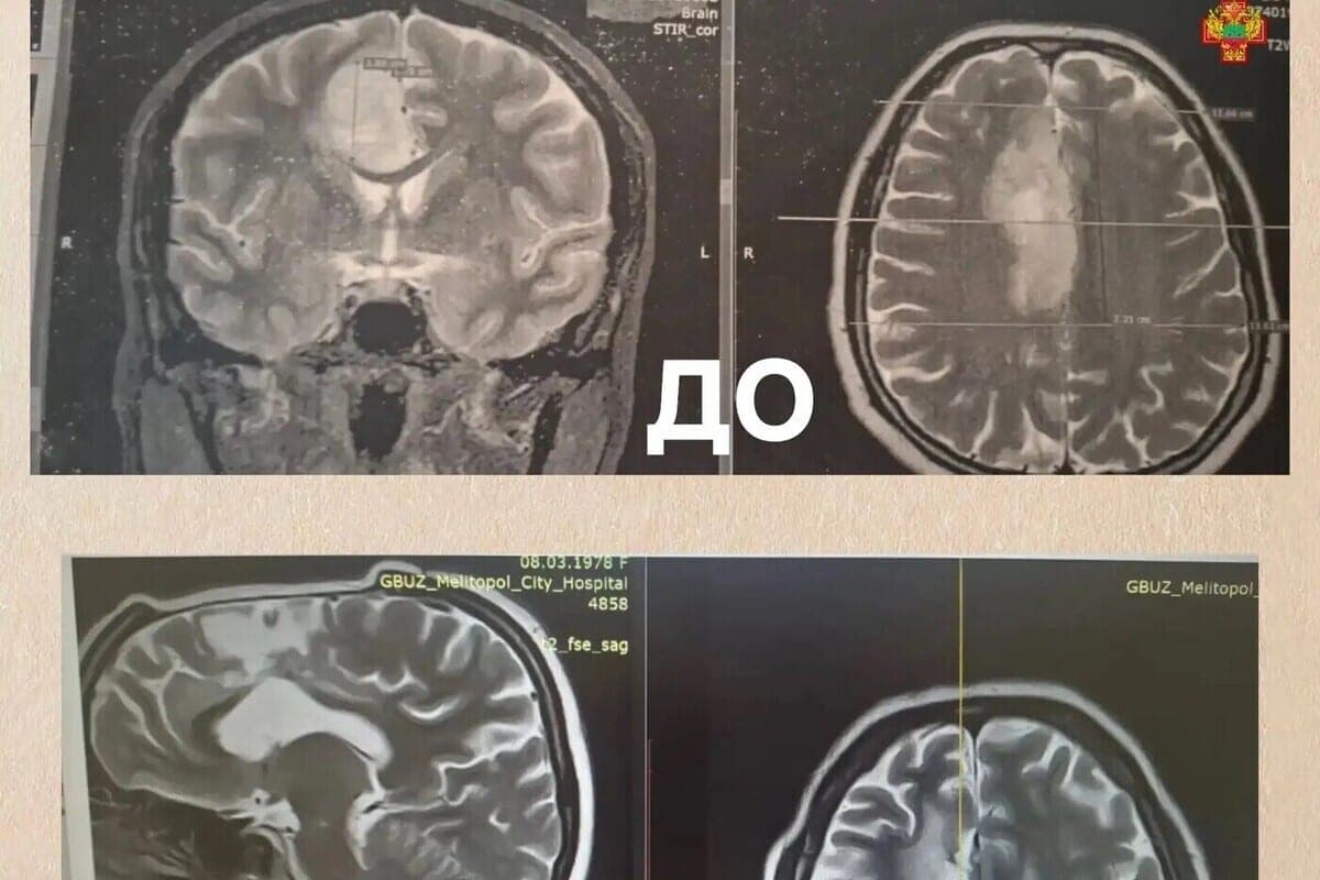 Врачи в Мелитополе спасли женщину от злокачественной опухоли мозга