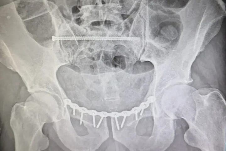 أطباء "فورونيز" أنقذوا رجلاً مصاباً بحوض شديد