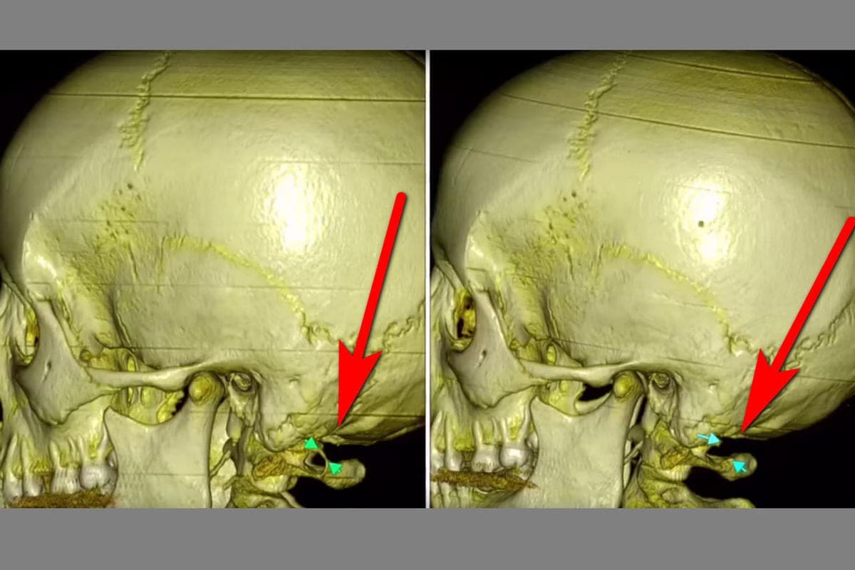 Neurosurgeons of Voronezh BSMP No1 rescue patients with a rare “Kimmerly anomaly”