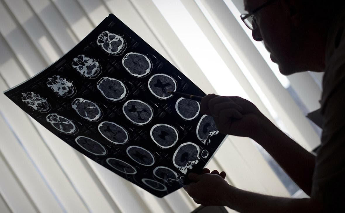 L'expert a expliqué pourquoi l'AVC est de plus en plus fréquent chez les jeunes