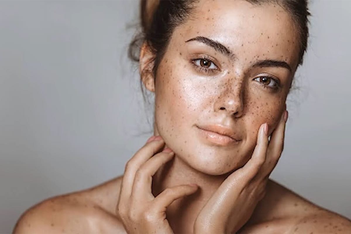 Nutriciologist explained where do pigment spots come from and how to improve the condition of the skin without lasers